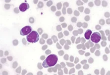 Nova terapia se mostra promissora contra câncer raro