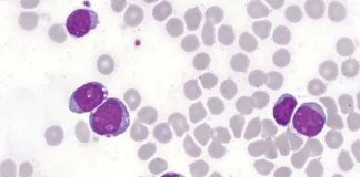 Nova terapia se mostra promissora contra câncer raro