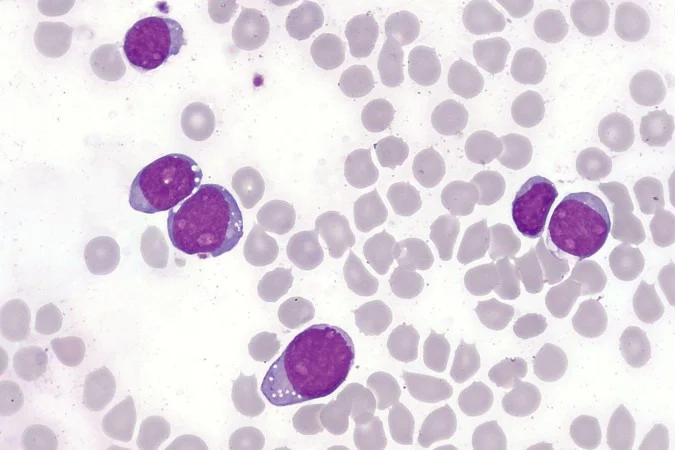 1_leucemia-61940067