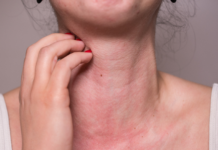 Alergia: quando o medicamento vira risco