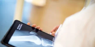 Casos de osteoporose devem disparar até 2050, inclusive no Brasil