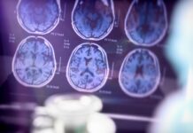 Diagnóstico precoce do Alzheimer ajuda pacientes e famílias a viverem com mais qualidade