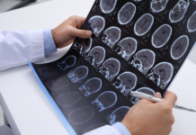 Esclerose múltipla é a principal causa de incapacidade neurológica em jovens adultos
