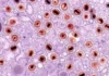 Herpes-zóster: quando uma dor comum merece atenção